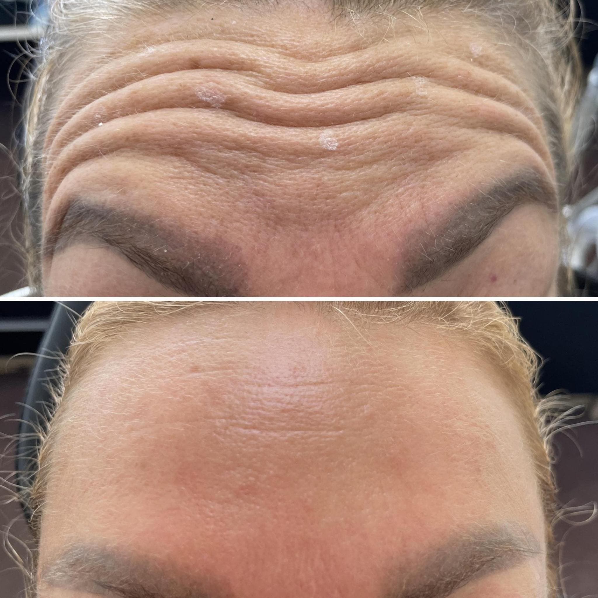 Výsledek aplikace botulotoxinu – fotografie 1