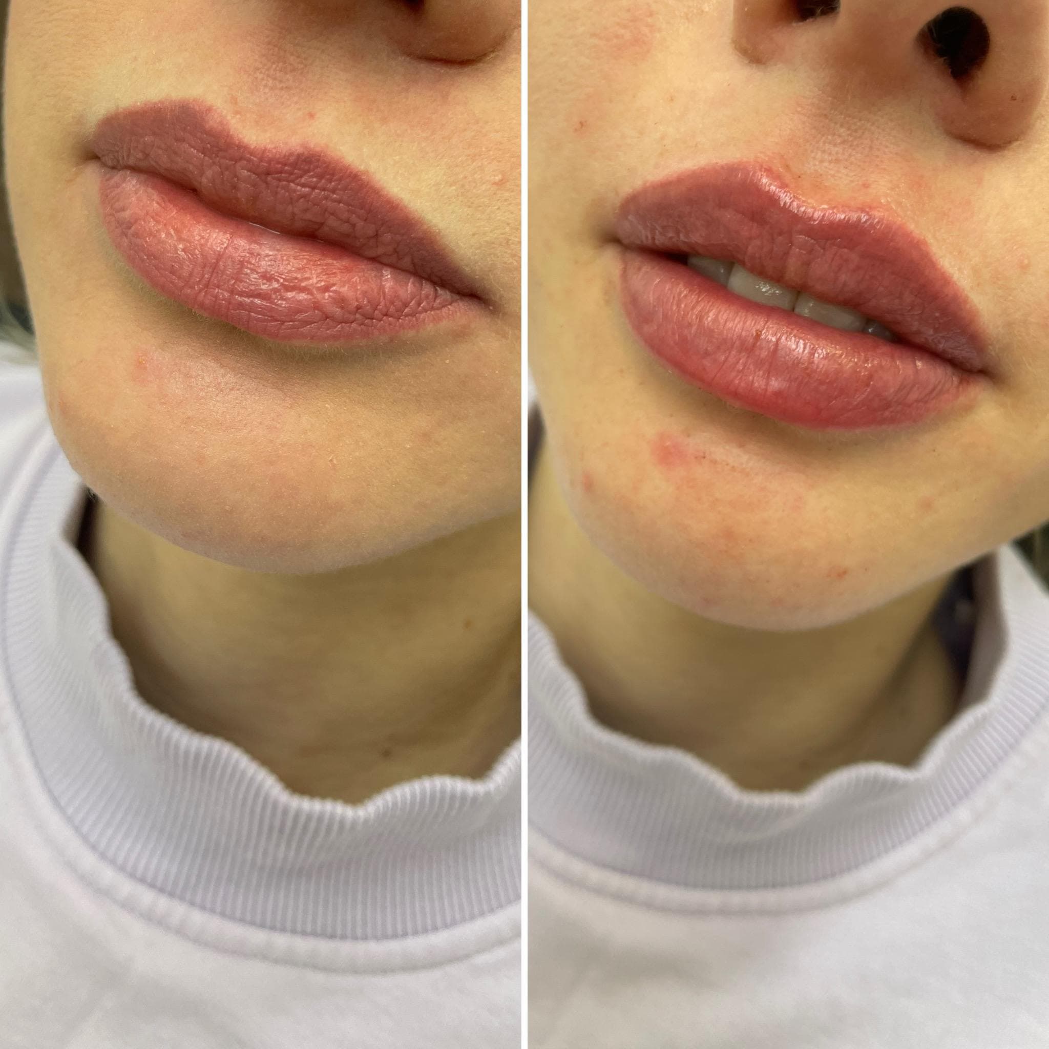 Výsledek augmentace rtů – fotografie 1