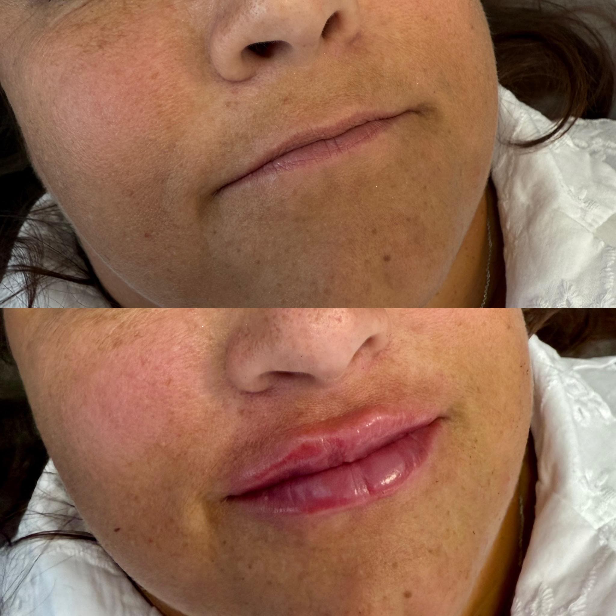 Výsledek augmentace rtů – fotografie 2