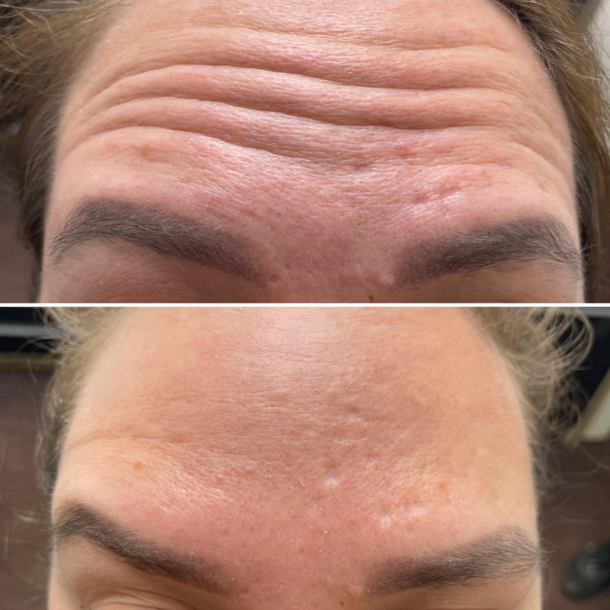 Výsledek aplikace botulotoxinu – fotografie 2