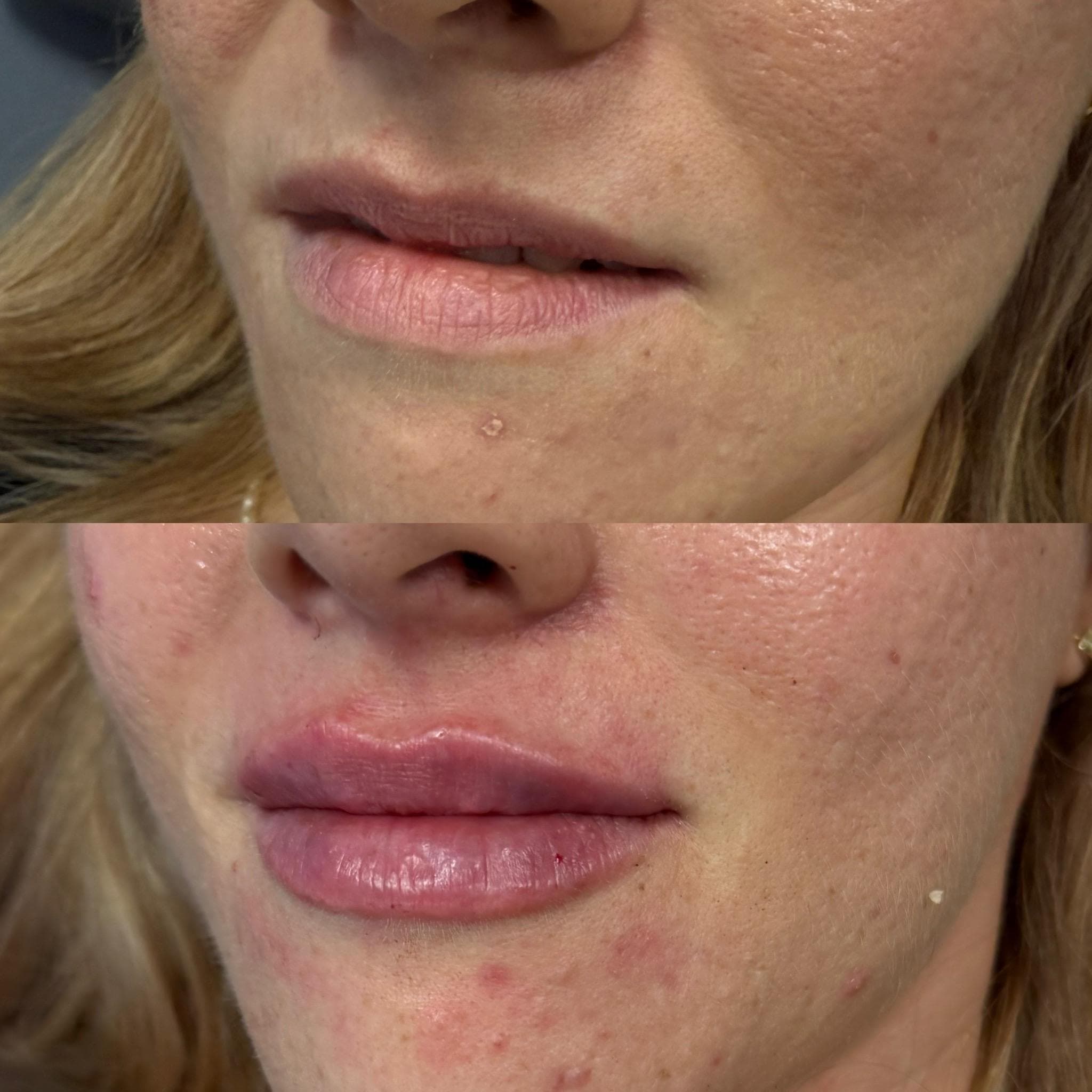 Výsledek augmentace rtů – fotografie 3
