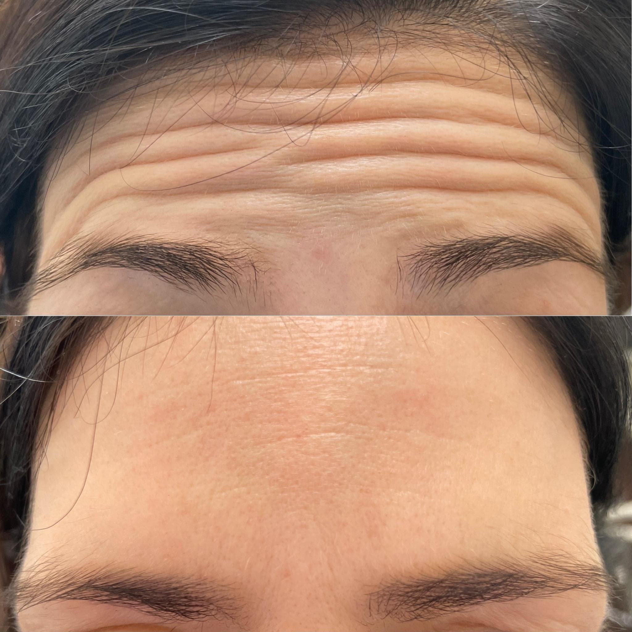 Výsledek aplikace botulotoxinu – fotografie 3