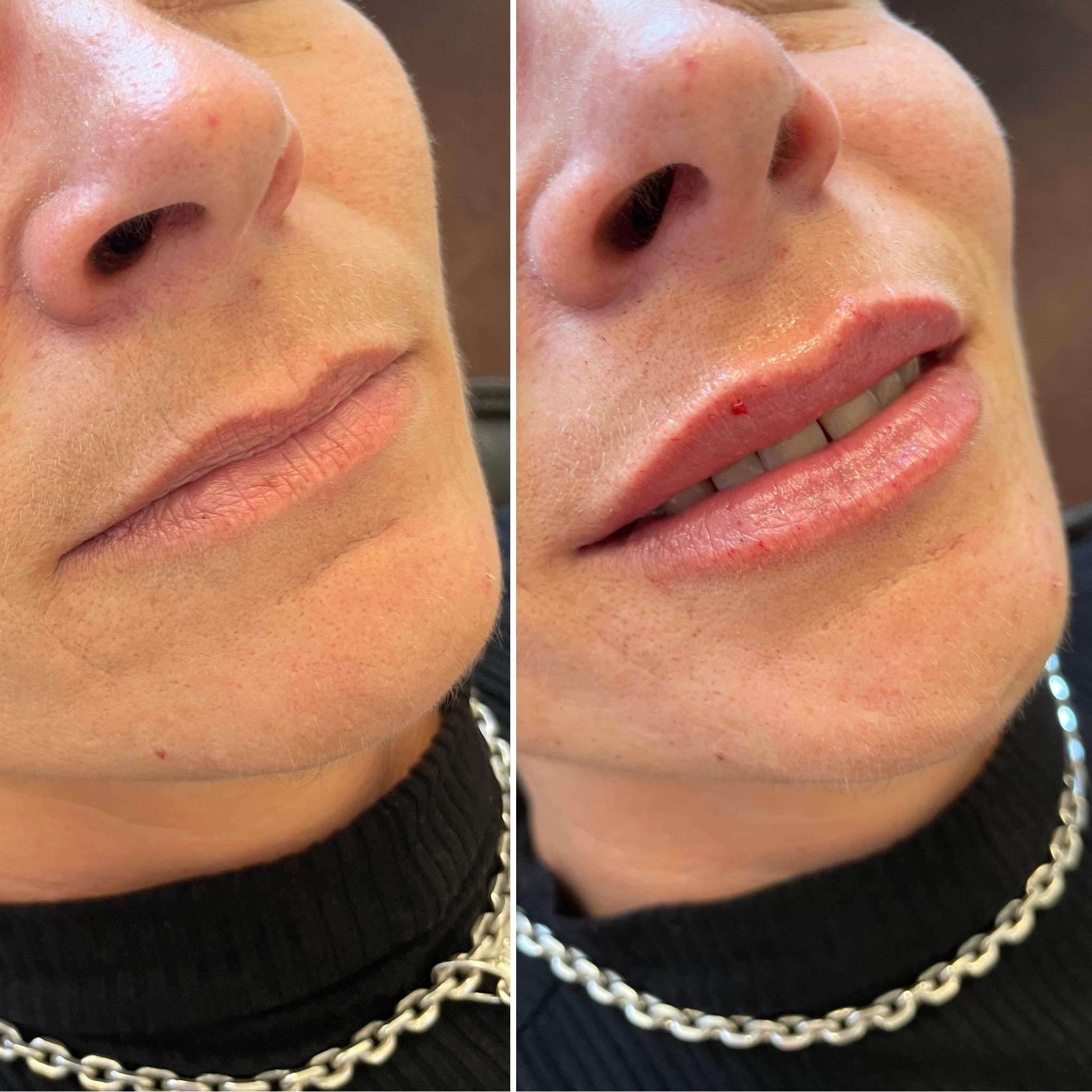 Výsledek augmentace rtů – fotografie 4