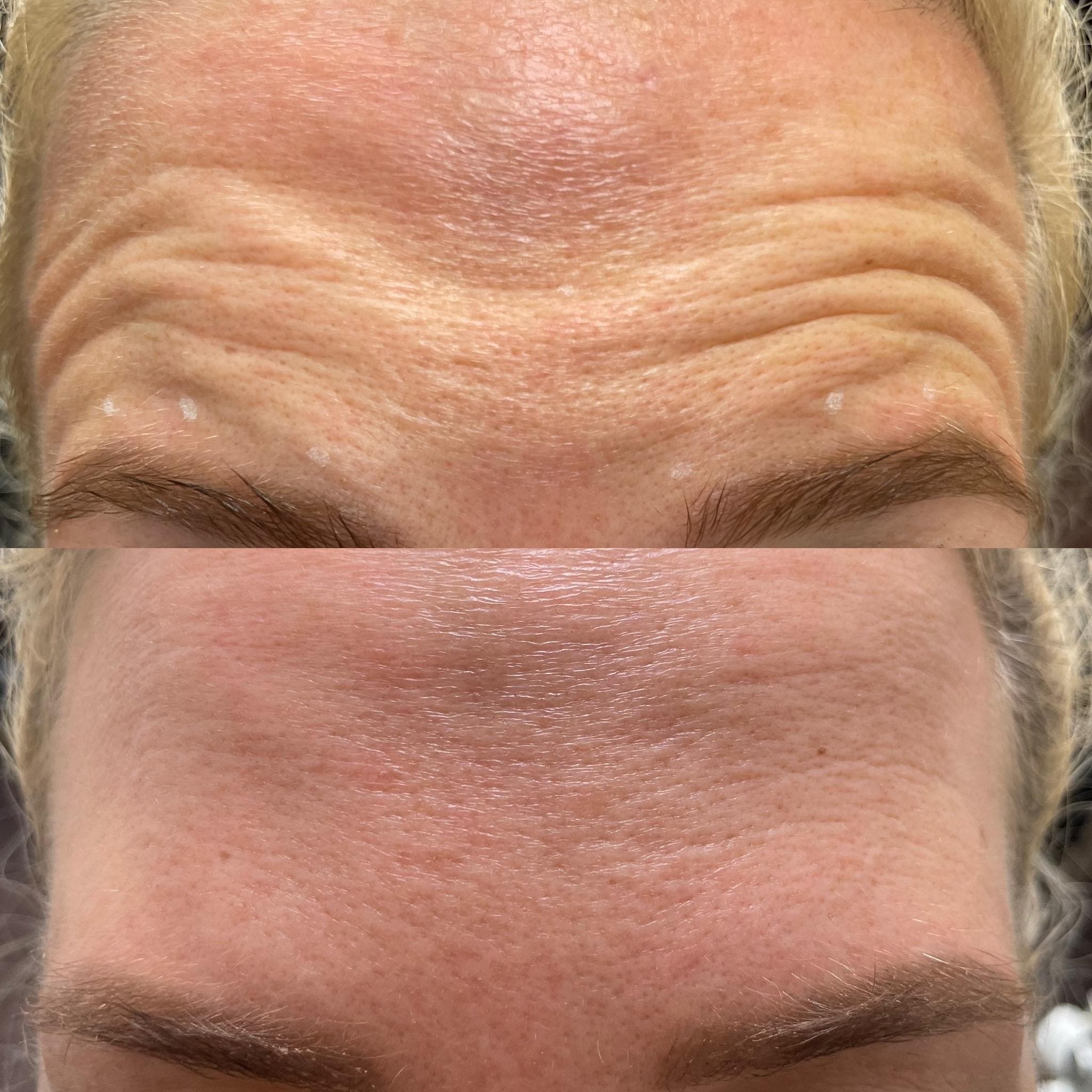 Výsledek aplikace botulotoxinu – fotografie 4