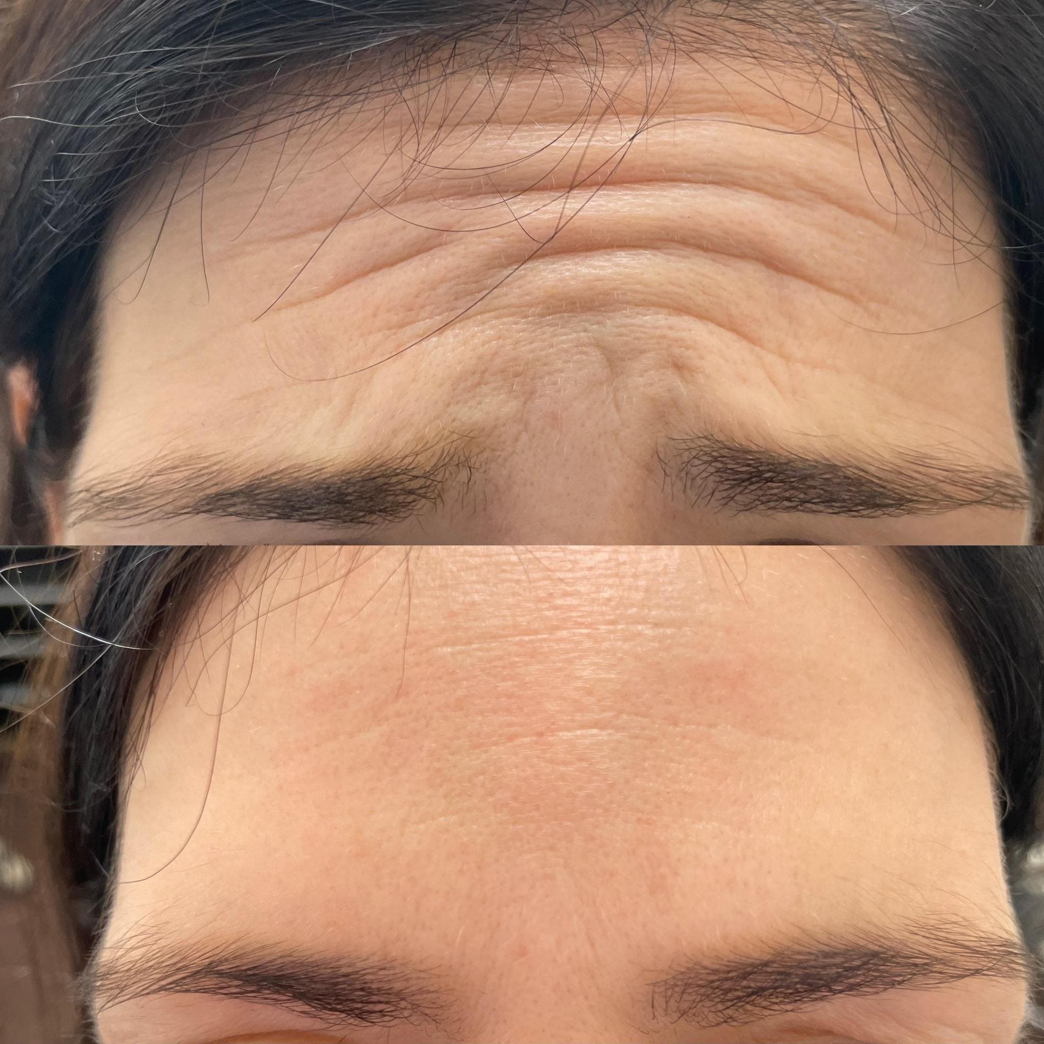 Výsledek aplikace botulotoxinu – fotografie 5