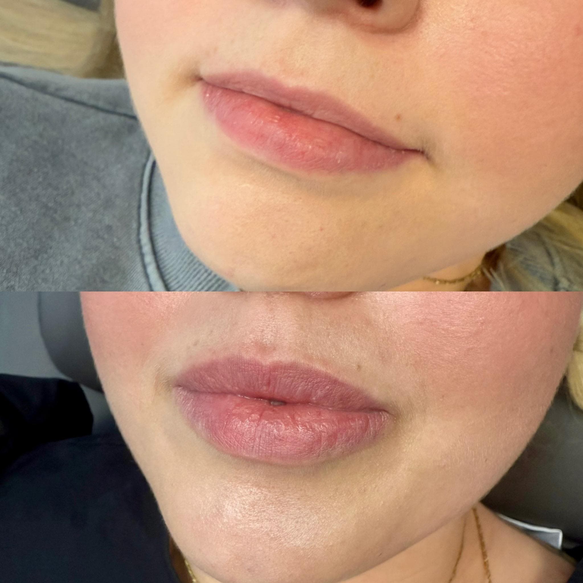Výsledek augmentace rtů – fotografie 5