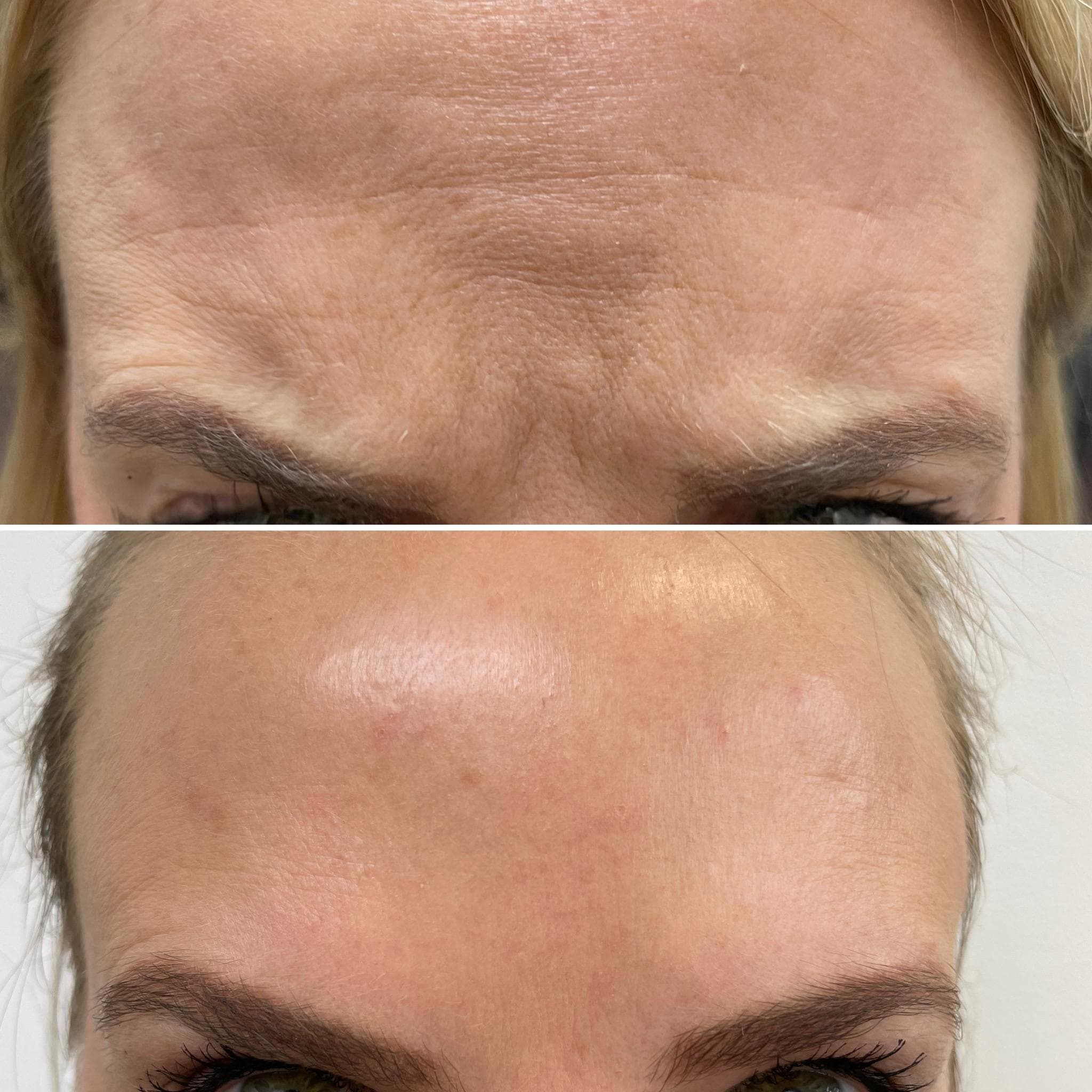 Výsledek aplikace botulotoxinu – fotografie 6