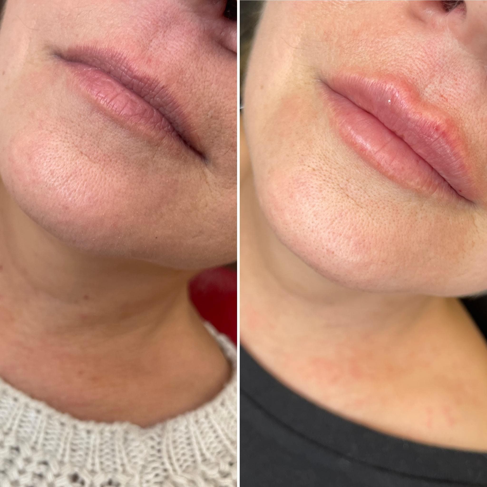 Výsledek augmentace rtů – fotografie 6