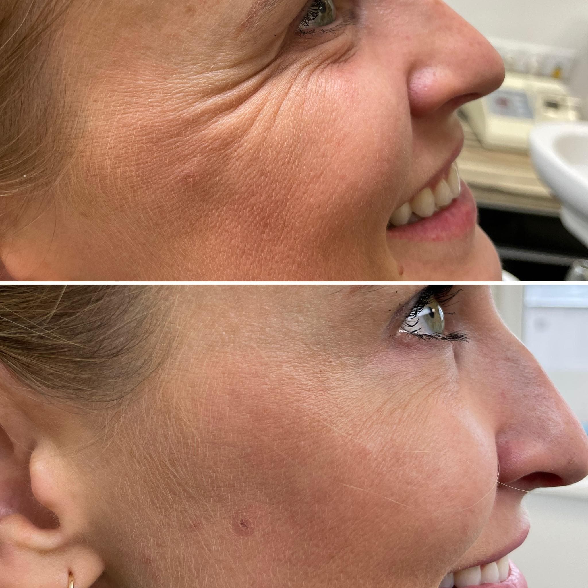 Výsledek aplikace botulotoxinu – fotografie 7