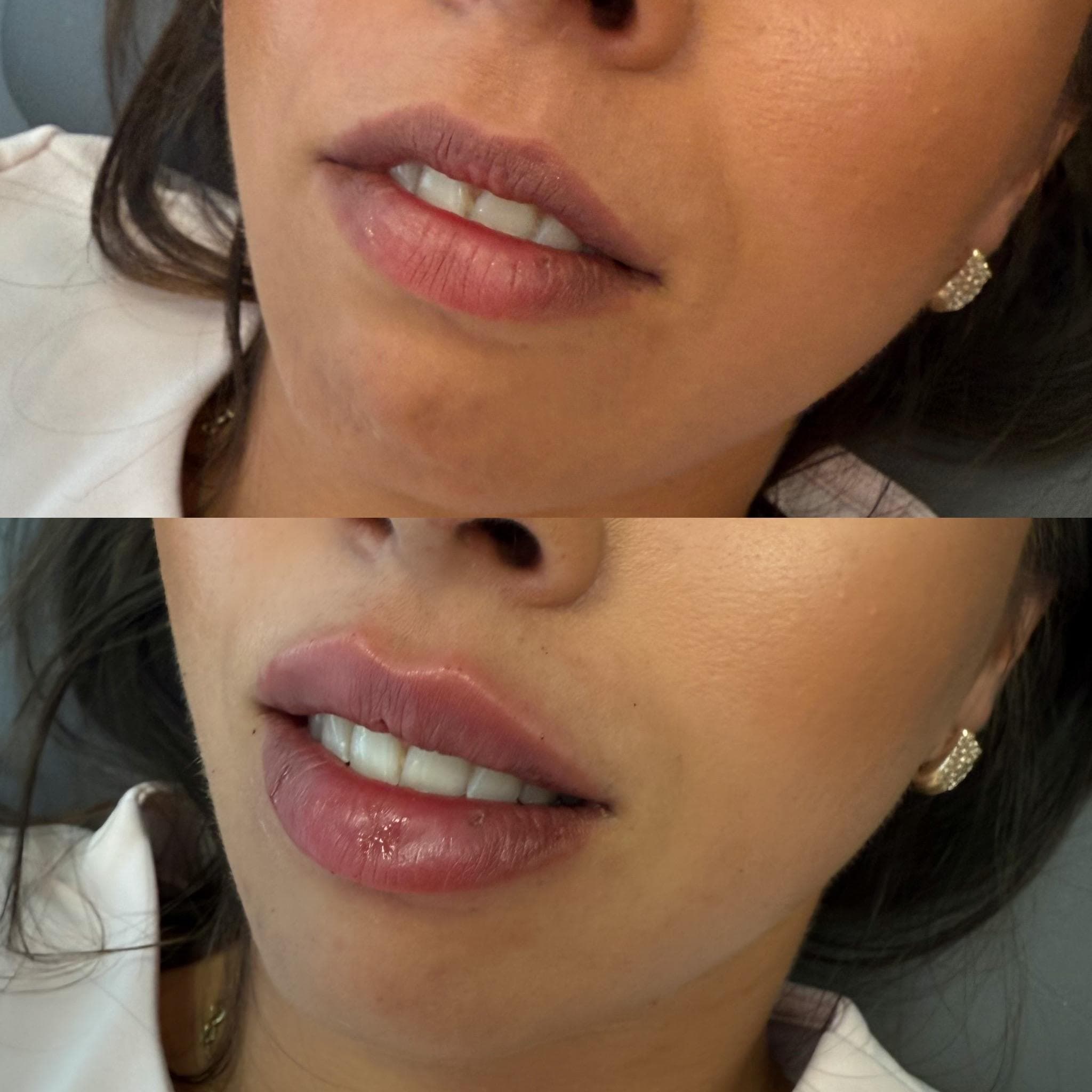 Výsledek augmentace rtů – fotografie 7