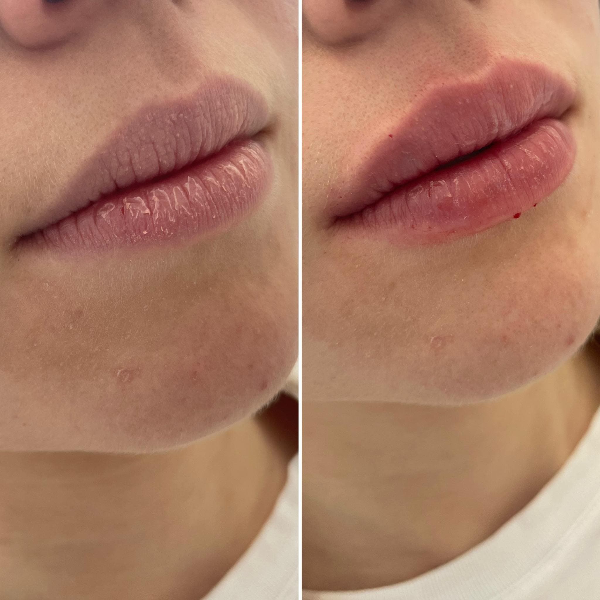 Výsledek augmentace rtů – fotografie 8