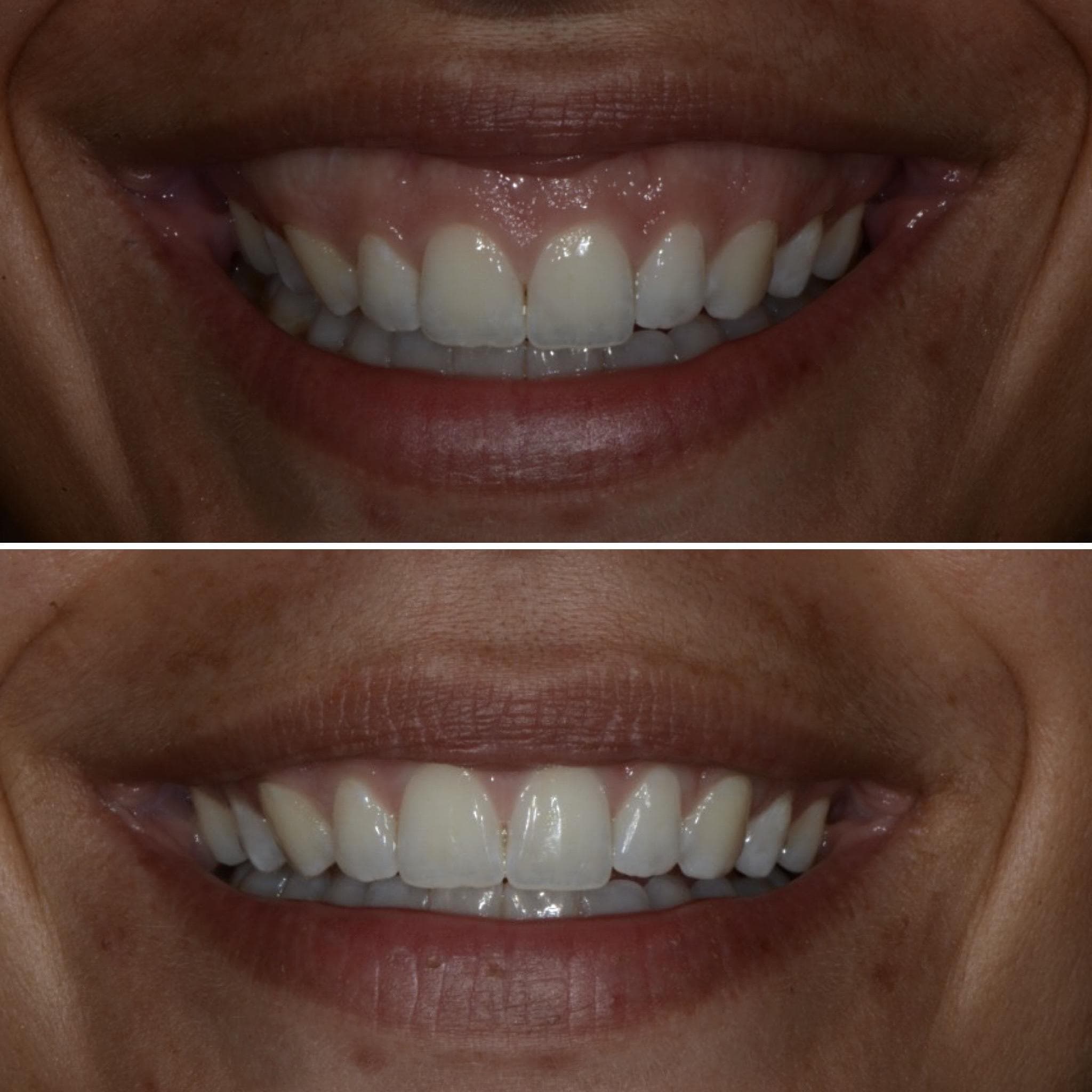 Výsledek aplikace botulotoxinu – fotografie 8