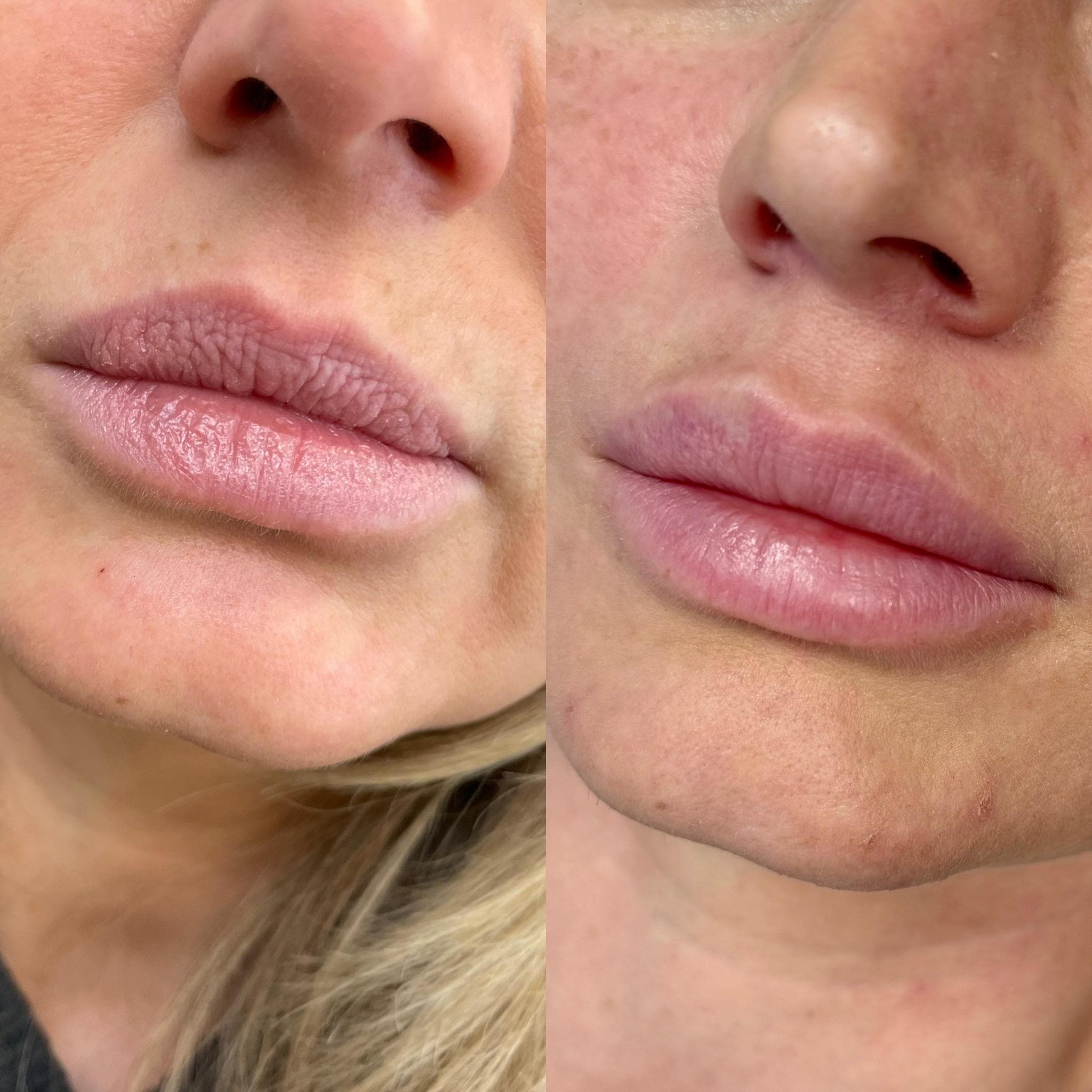 Výsledek augmentace rtů – fotografie 9