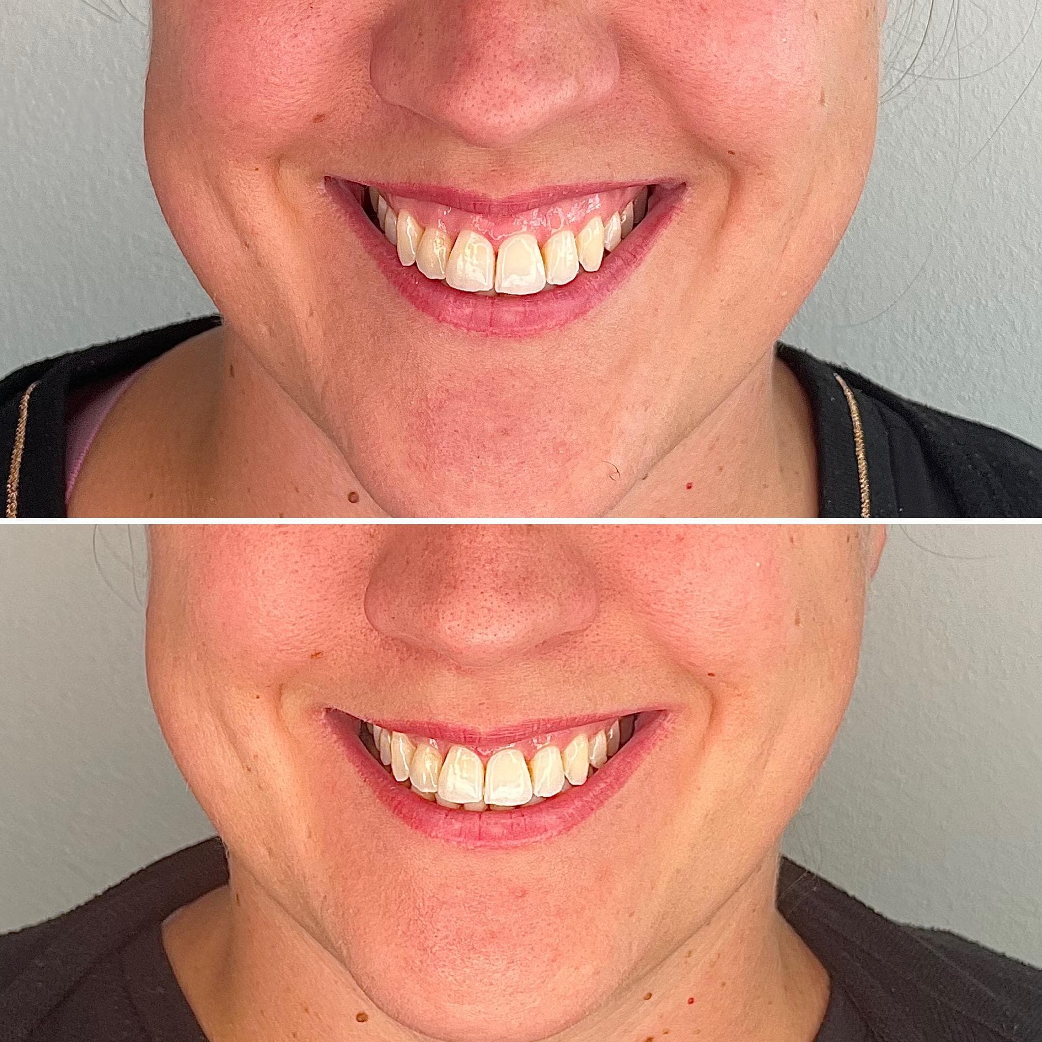 Výsledek aplikace botulotoxinu – fotografie 9