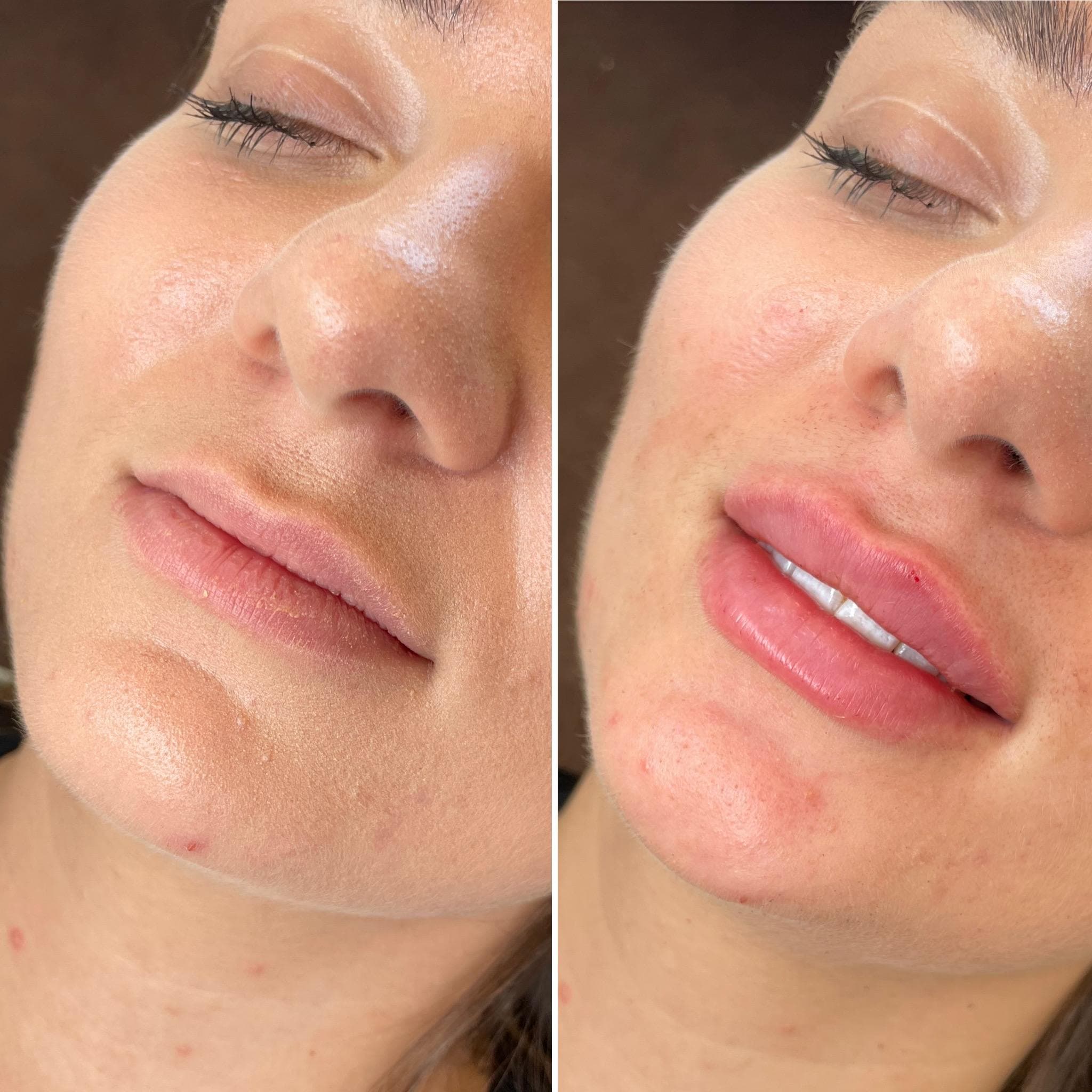 Výsledek augmentace rtů – fotografie 10