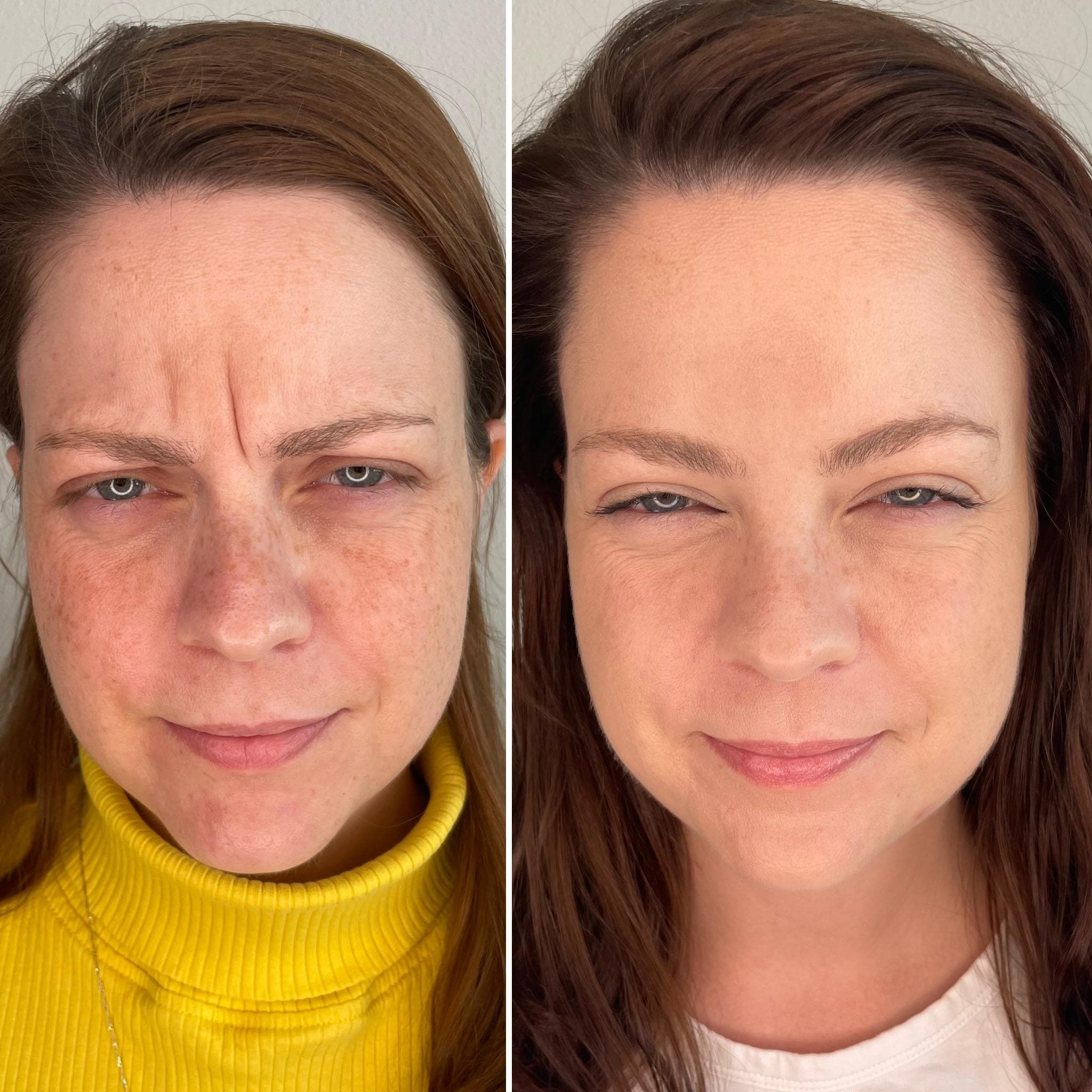 Výsledek aplikace botulotoxinu – fotografie 10