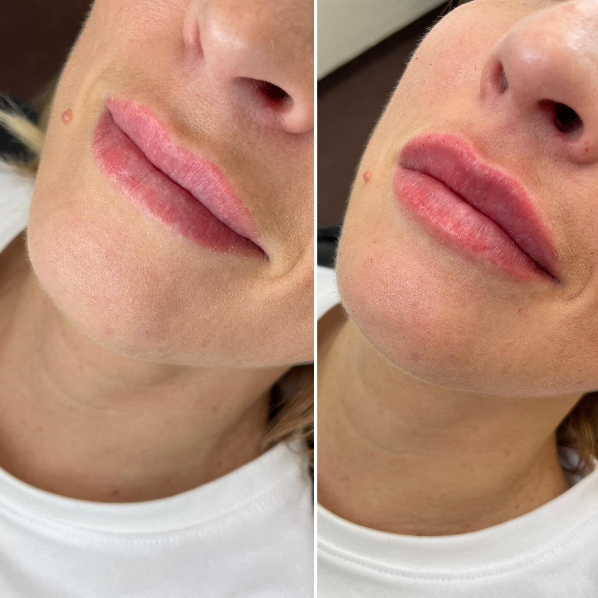 Výsledek augmentace rtů – fotografie 11