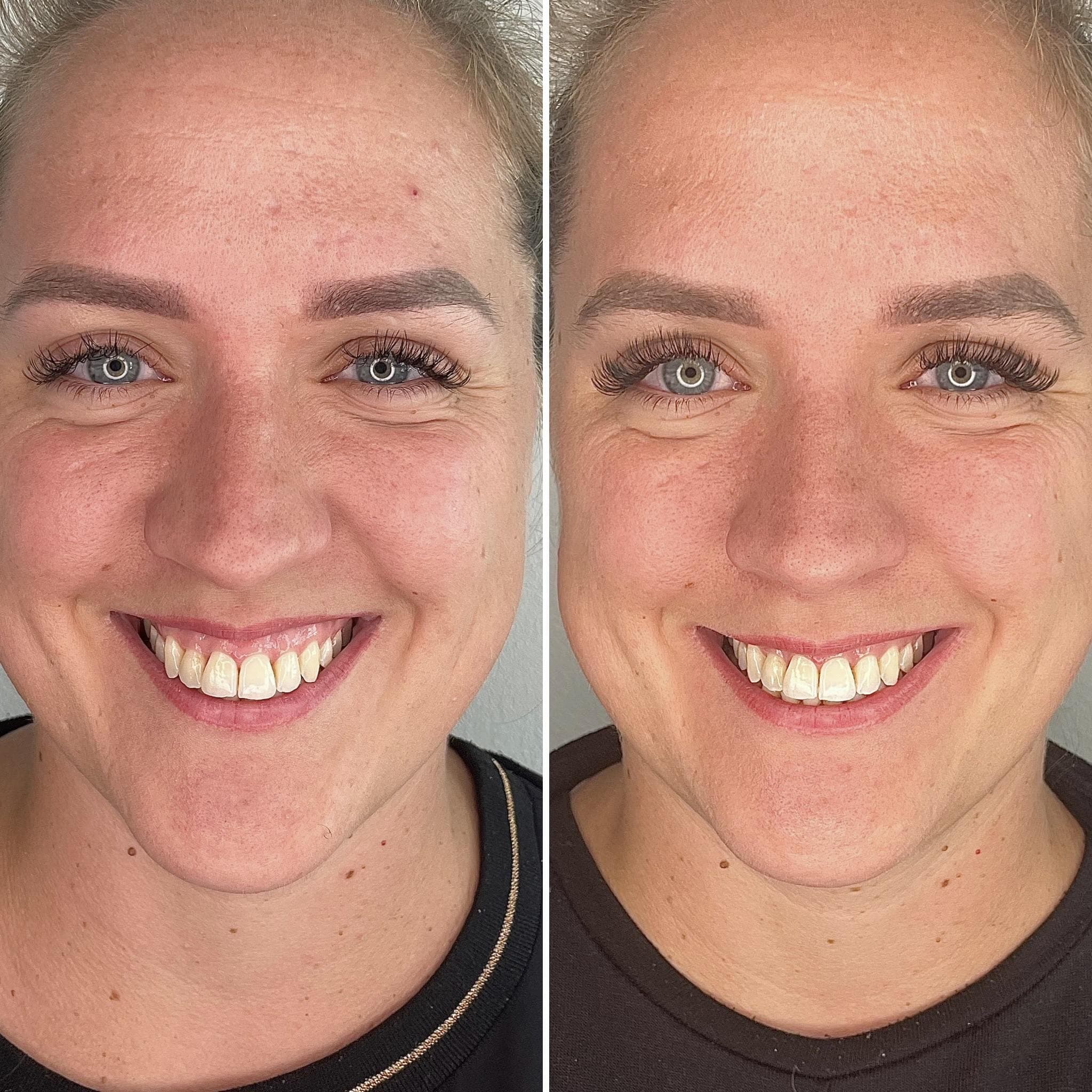 Výsledek aplikace botulotoxinu – fotografie 11