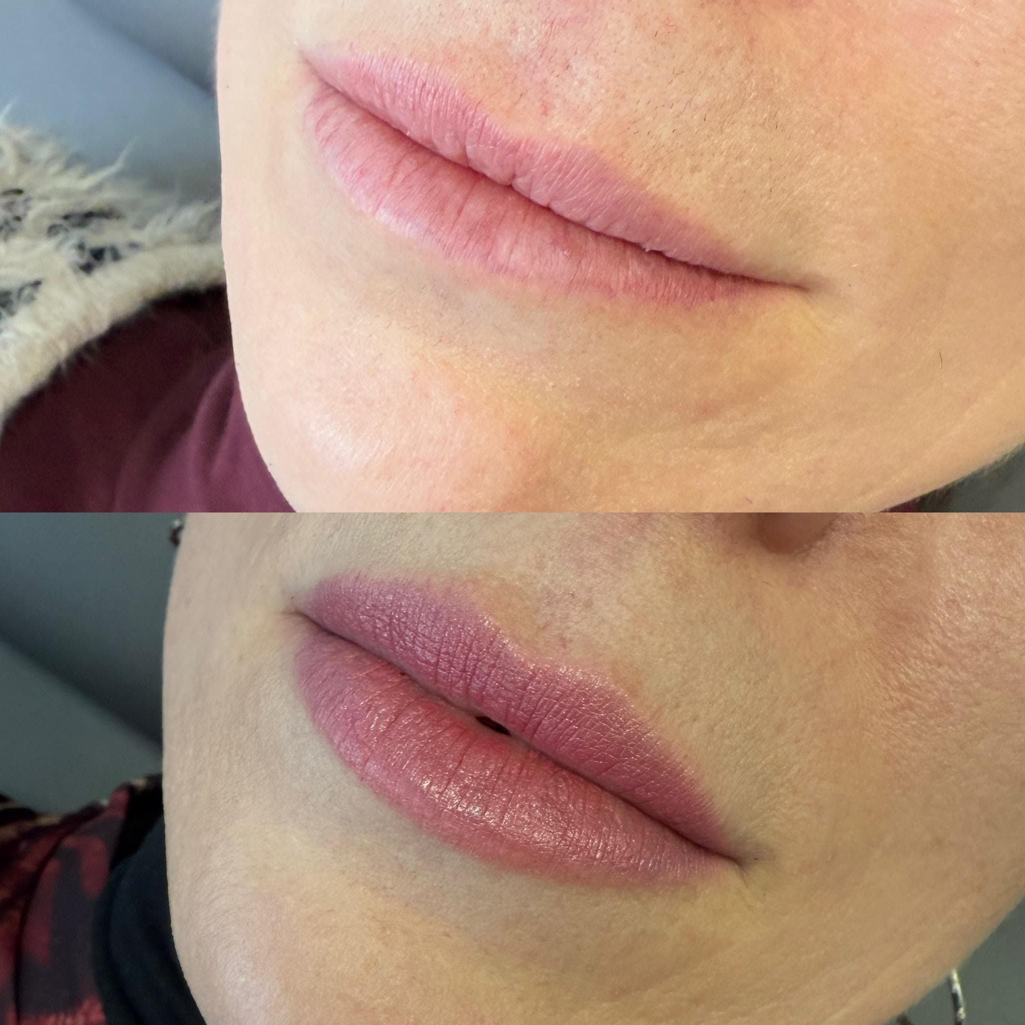 Výsledek augmentace rtů – fotografie 12