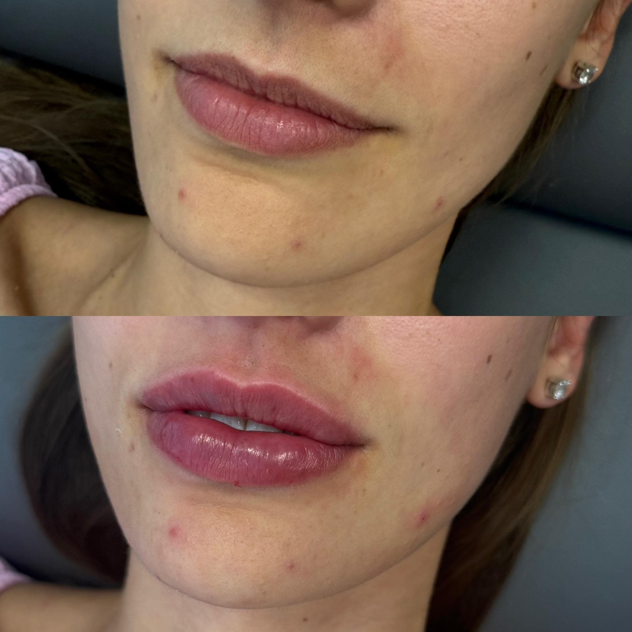 Výsledek augmentace rtů – fotografie 13