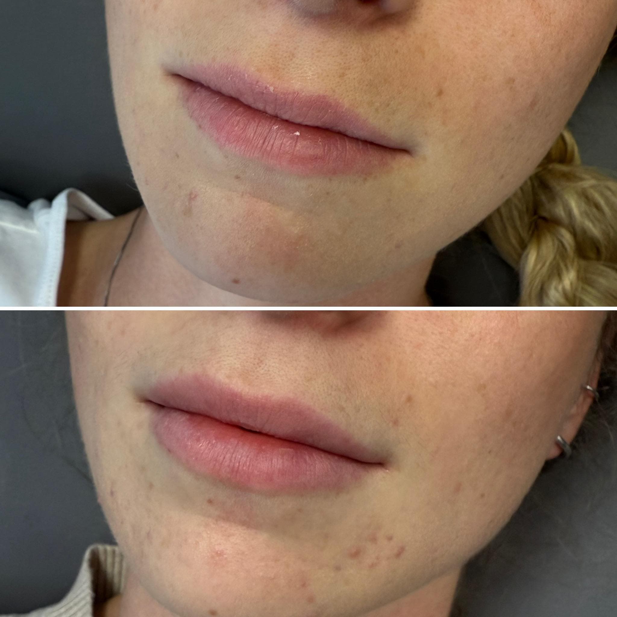 Výsledek augmentace rtů – fotografie 14