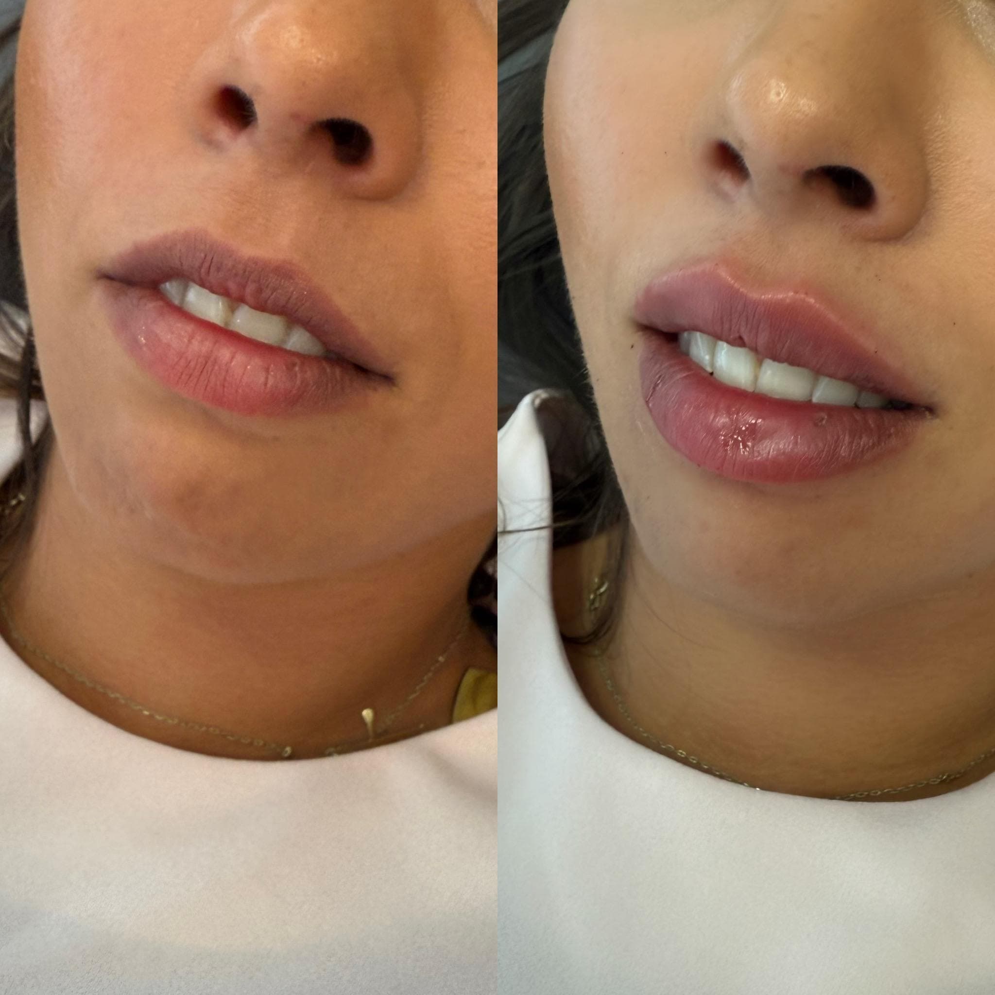 Výsledek augmentace rtů – fotografie 15