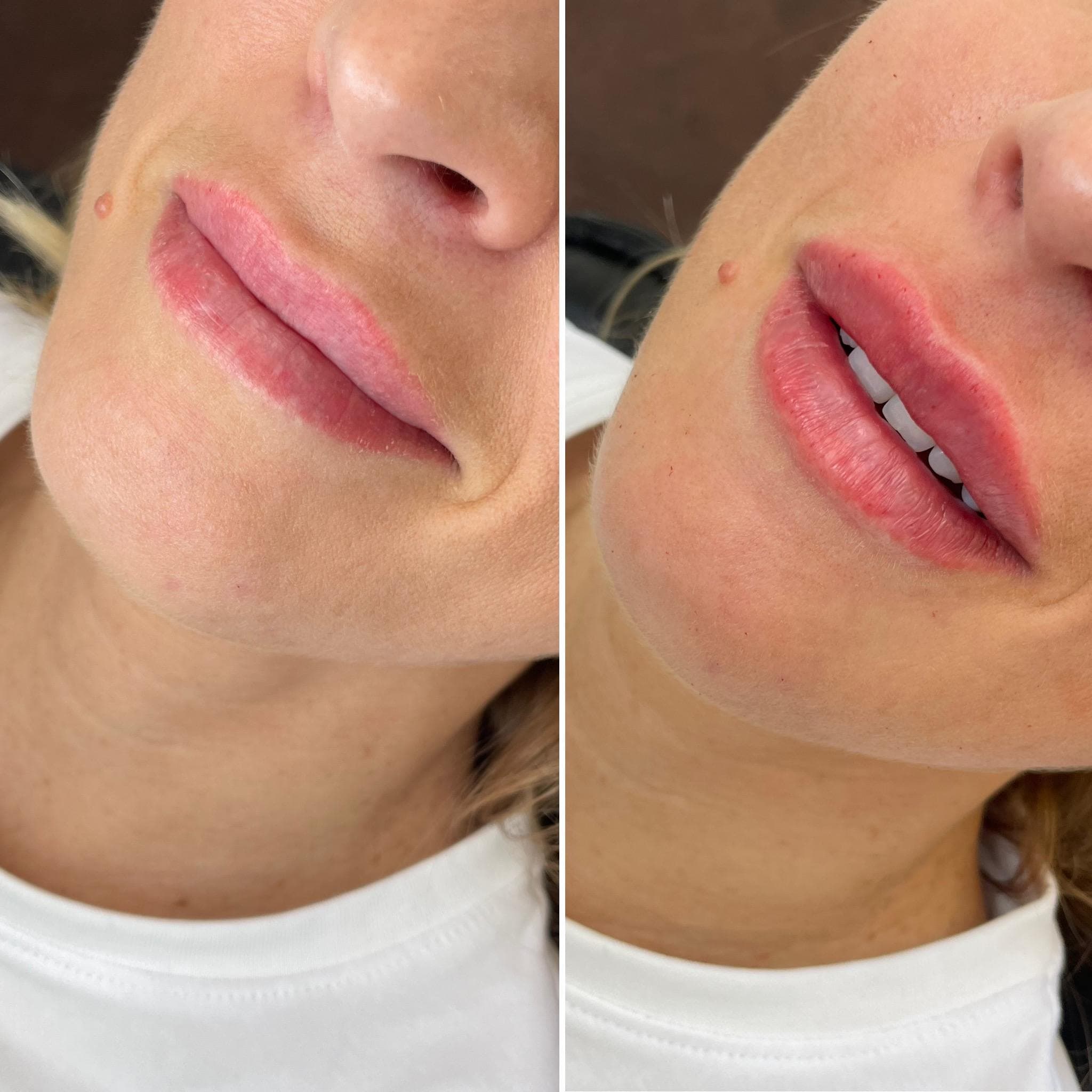 Výsledek augmentace rtů – fotografie 16