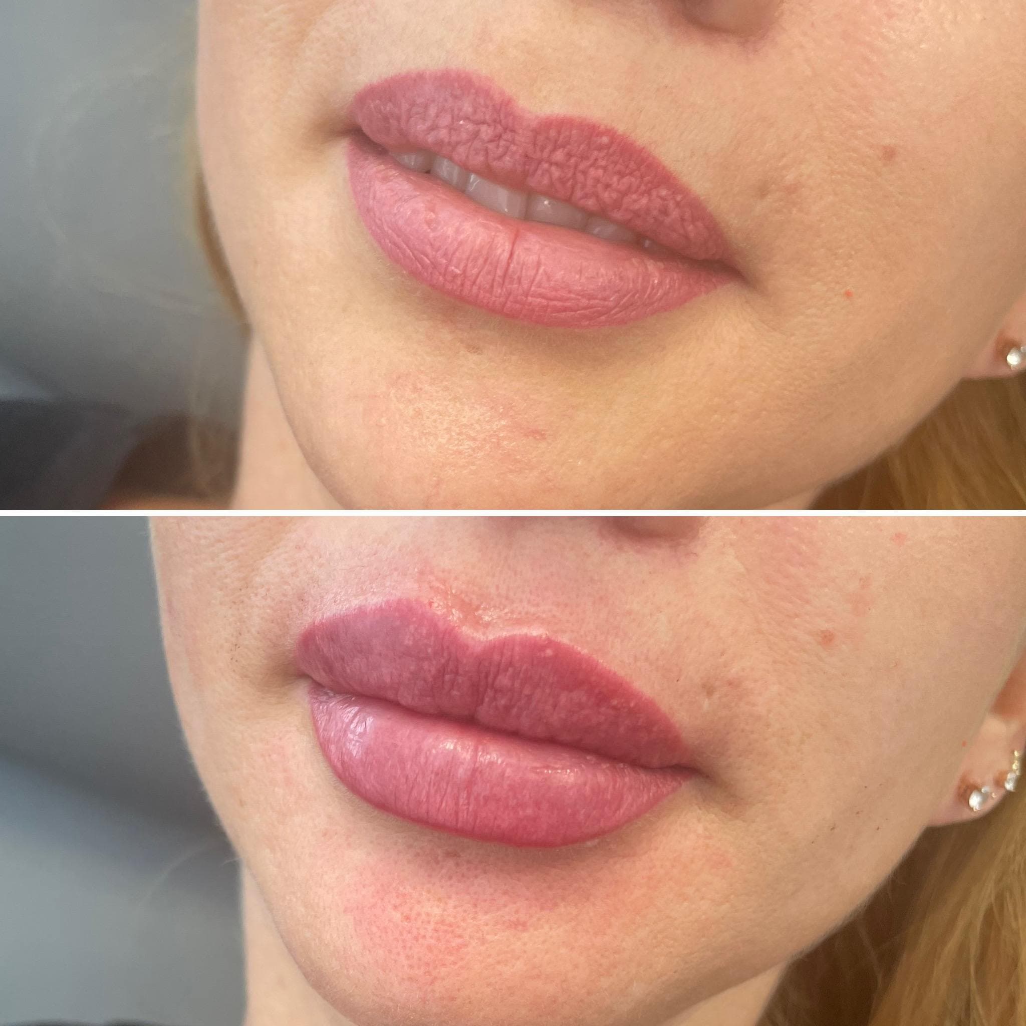 Výsledek augmentace rtů – fotografie 17