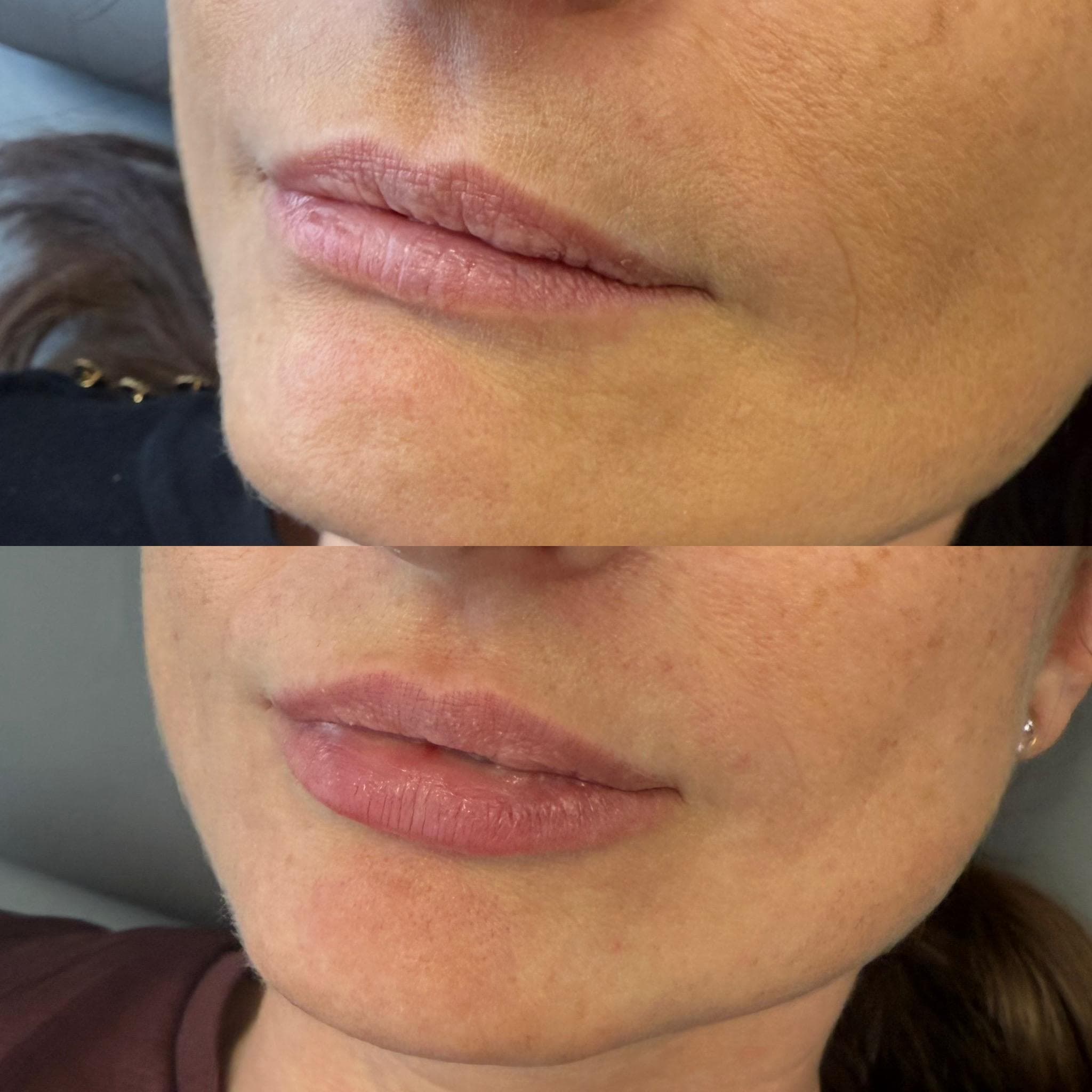 Výsledek augmentace rtů – fotografie 18