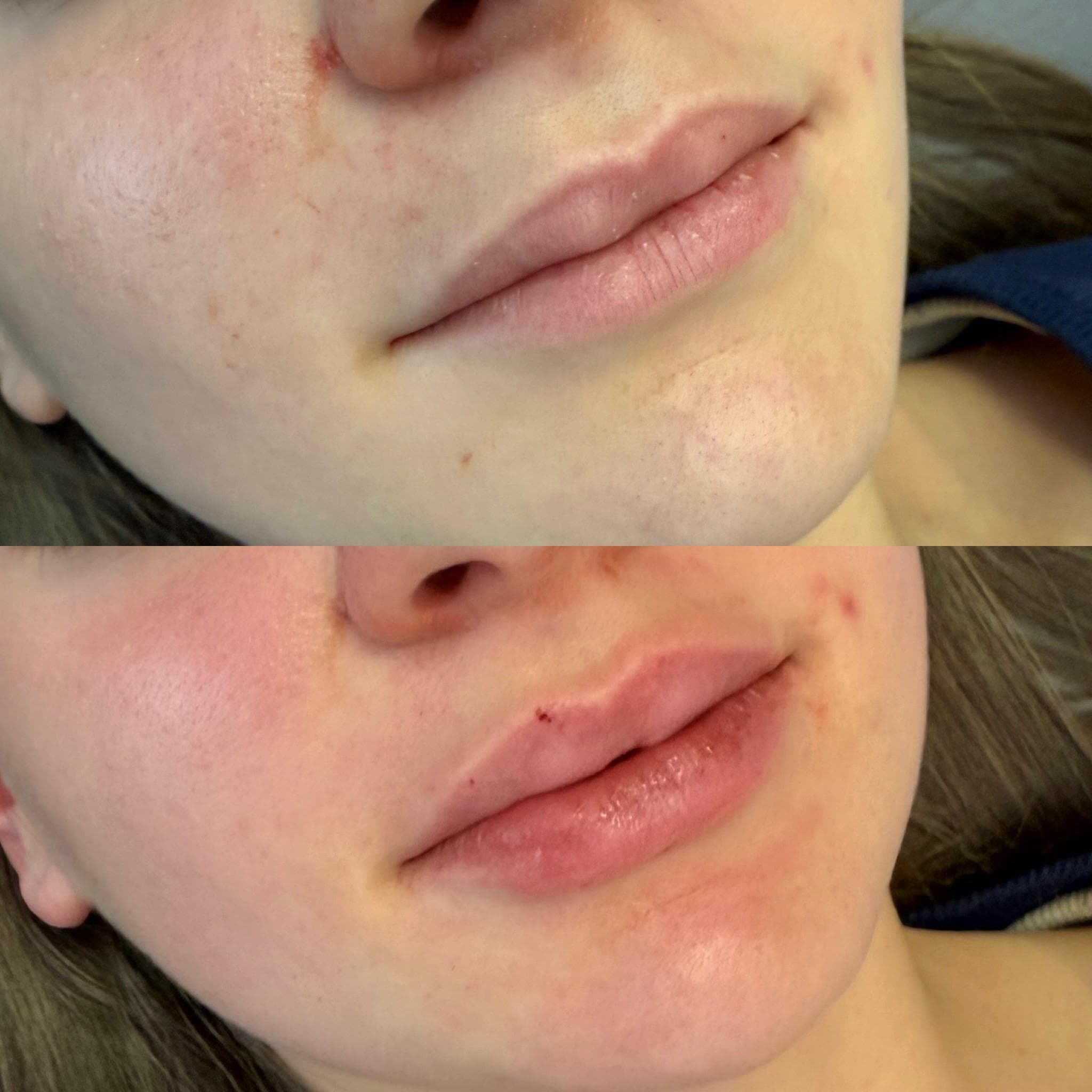 Výsledek augmentace rtů – fotografie 19